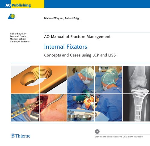 (eBook PDF)AO Manual of Fracture Management - Internal Fixators by Michael Wagner , Robert Frigg