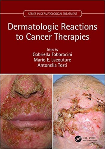 (eBook PDF)Dermatologic Reactions to Cancer Therapies by Gabriella Fabbrocini , Mario E. Lacouture , Antonella Tosti