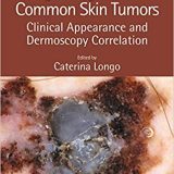 (eBook PDF)Diagnosing the Less Common Skin Tumors by Caterina Longo