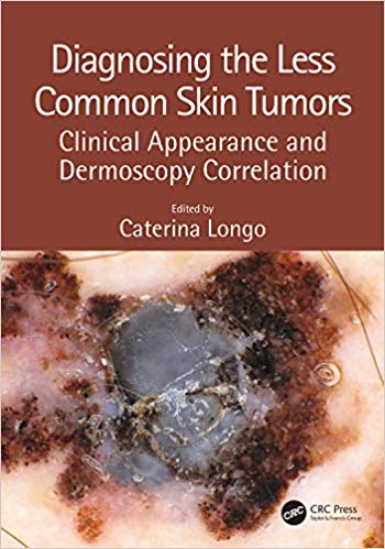 (eBook PDF)Diagnosing the Less Common Skin Tumors by Caterina Longo