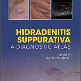 (eBook PDF)Hidradenitis Suppurativa: A Diagnostic Atlas by Giuseppe Micali