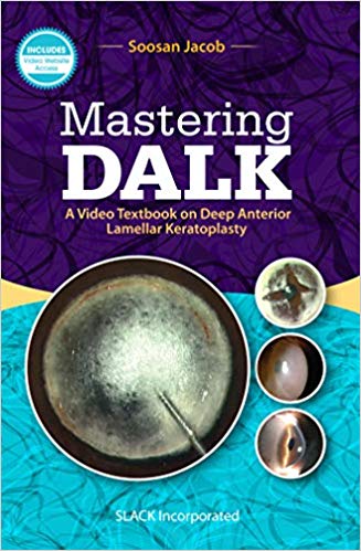 (eBook PDF)Mastering DALK a video textbook on deep anterior lamellar by Soosan Jacob MS FRCS DNB