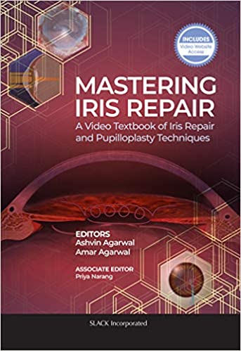 (eBook PDF)Mastering Iris Repair A Video Textbook of Iris Repair and Pupilloplasty Techniques by Ashvin Agarwal (author)